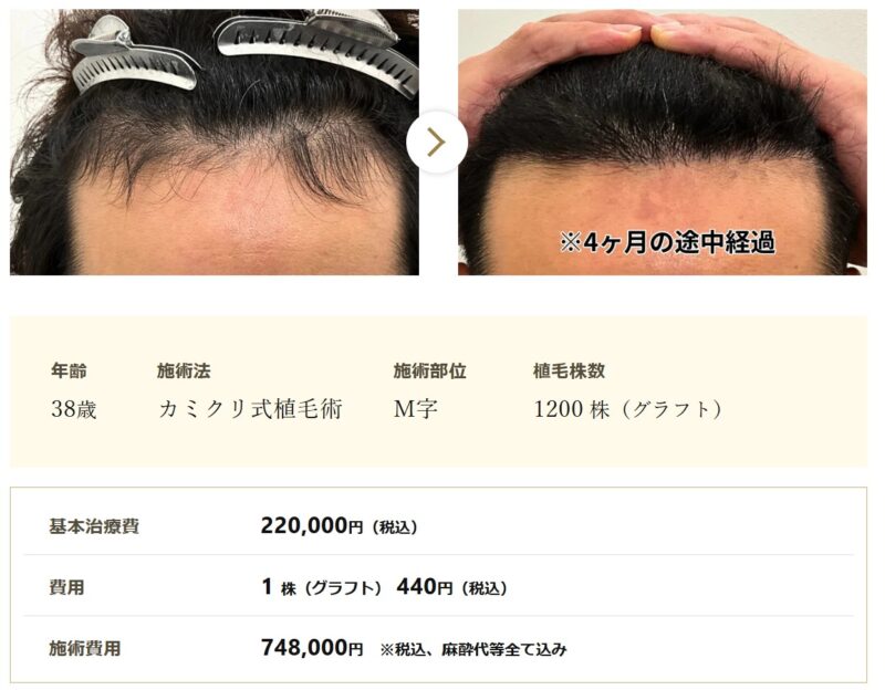 カミノクリニックの症例写真_カミクリ式植毛術でグラフト1200株をM字に植毛した症例写真