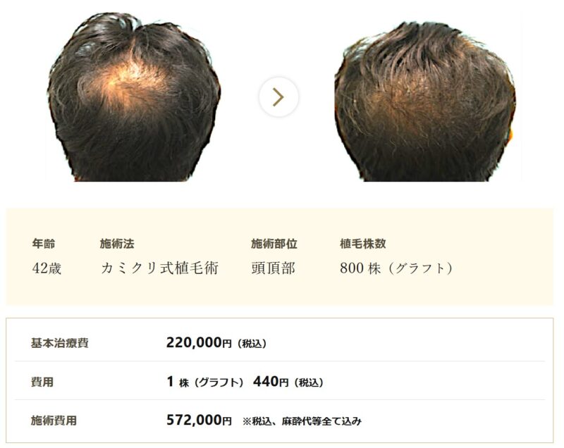 カミノクリニックの症例写真_カミクリ式植毛術でグラフト800株を後頭部に植毛した症例写真